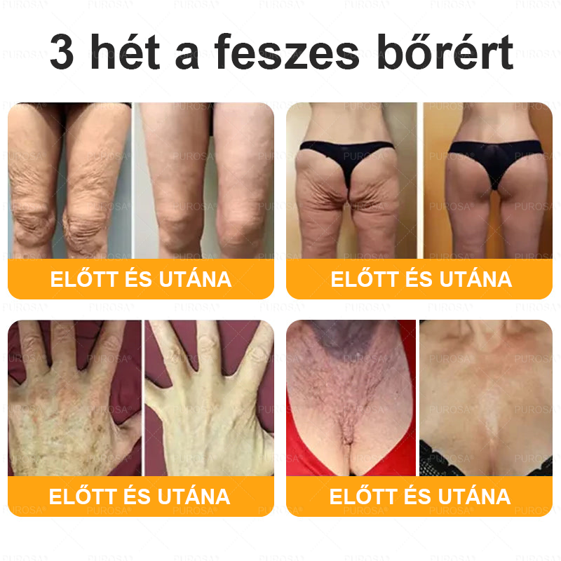 👍PUROSA® Magyarországon készült és innen szállítjuk ✨ PUROSA® Méhméreg Bőrregeneráló Krém 🔥 UTOLSÓ NAP – 80% KEDVEZMÉNY