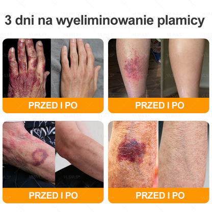 🌟 Wyprodukowano i wysyłane z Polski 🇵🇱 VLSVLS® Regenerujący Krem z Jadem Pszczelim🔥 OSTATNI DZIEŃ: 80% ZNIŻKI