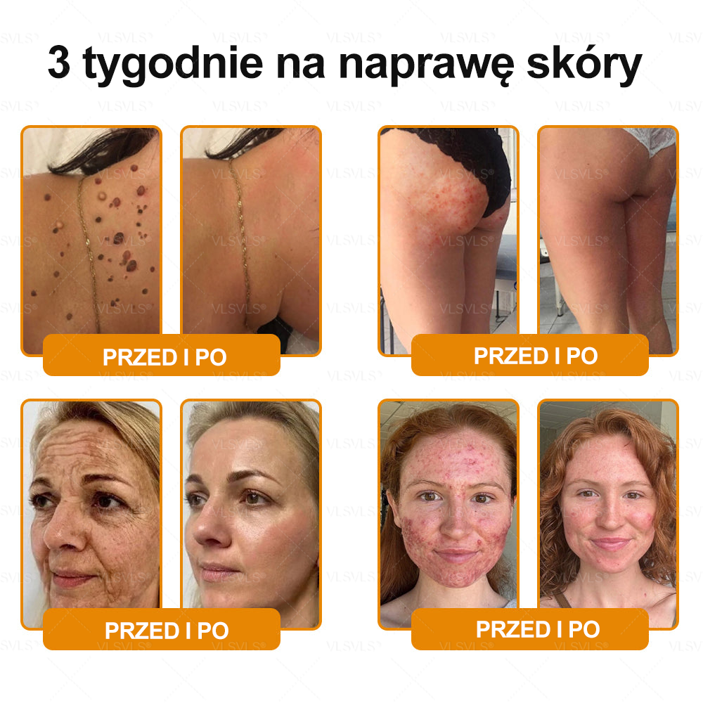 🌟 Wyprodukowano i wysyłane z Polski 🇵🇱 VLSVLS® Regenerujący Krem z Jadem Pszczelim🔥 OSTATNI DZIEŃ: 80% ZNIŻKI